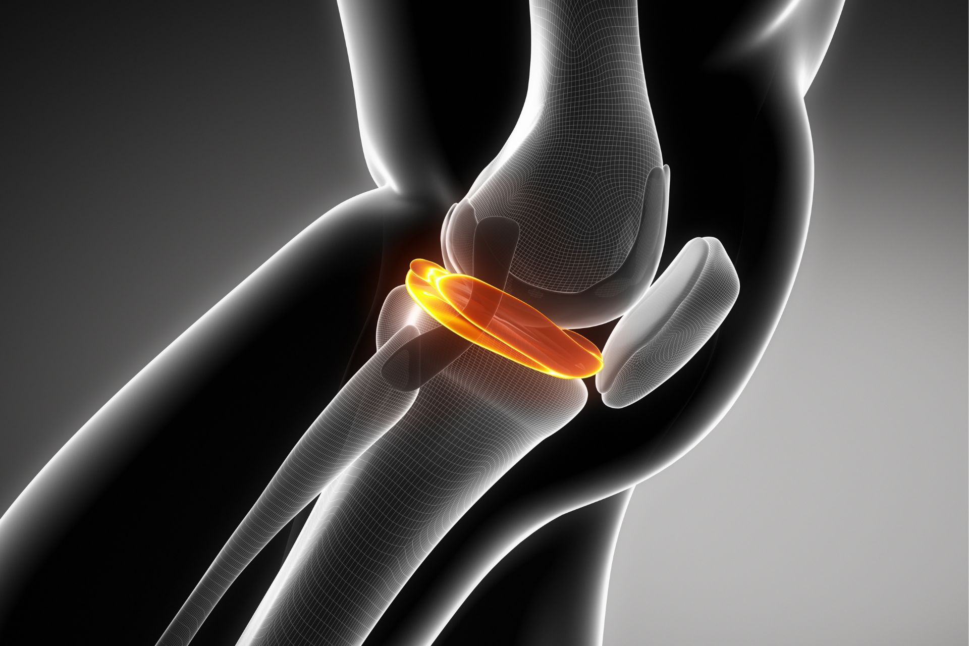 Understanding meniscus tears