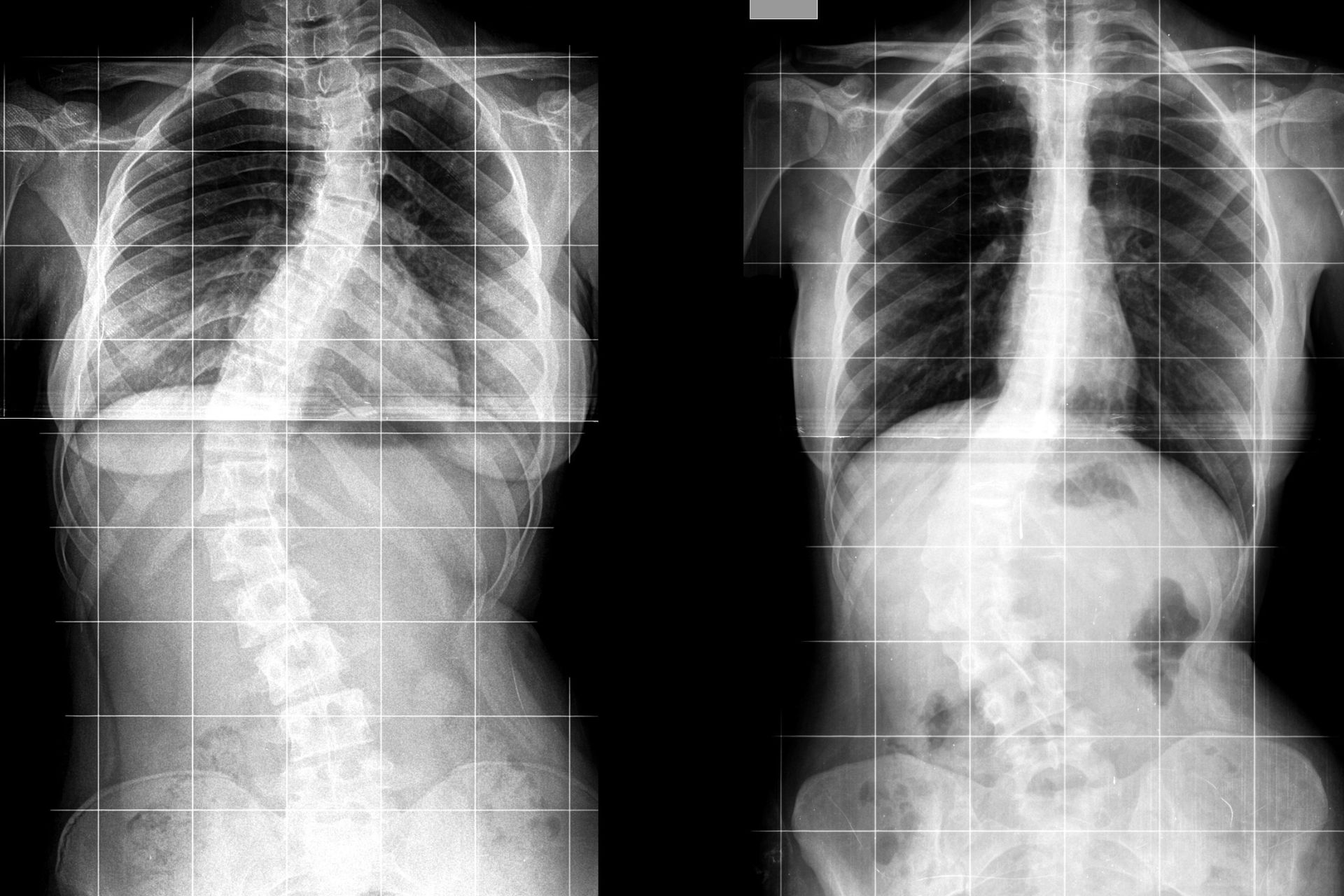 physical therapy evaluation for scoliosis