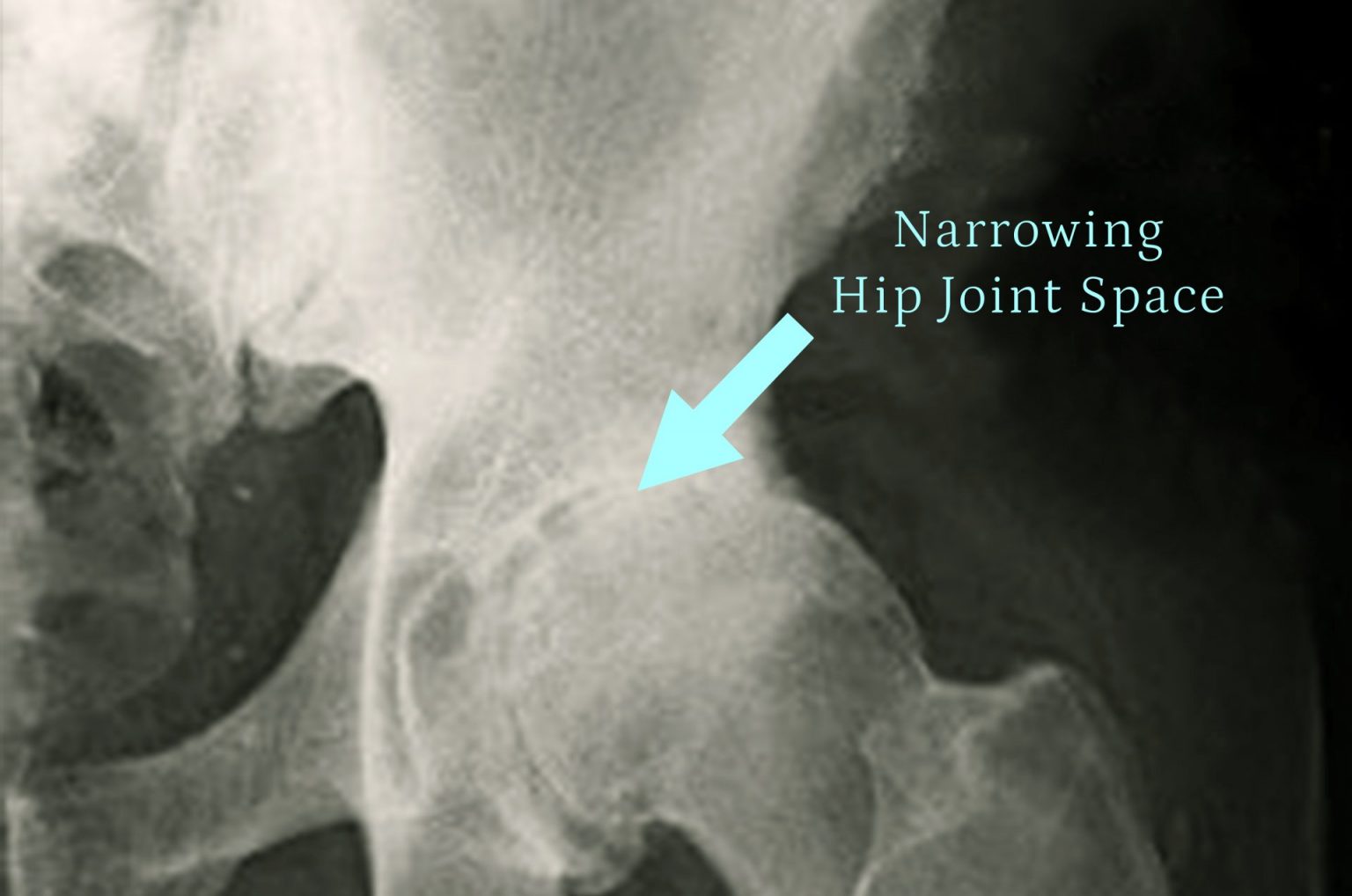 Signs You May Need Hip Replacement Surgery Physiotherapy Tips